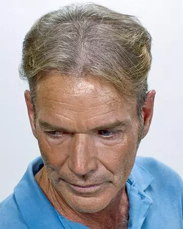   solutions before after mens gallery hair restoration systems 06 hair restoration systems before and after photo 02